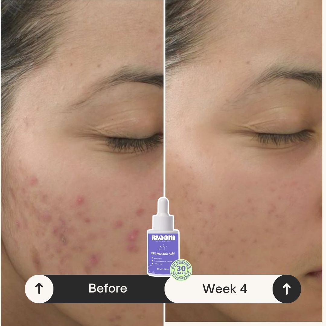 Bloom™ Mandelic Acid Serum